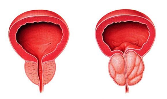 Prostata normale e infiammata (prostatite)