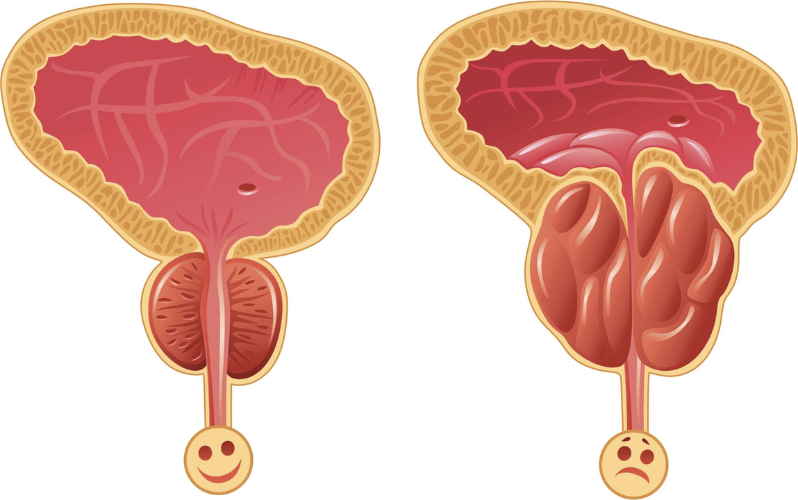 Come determinare la presenza di prostatite