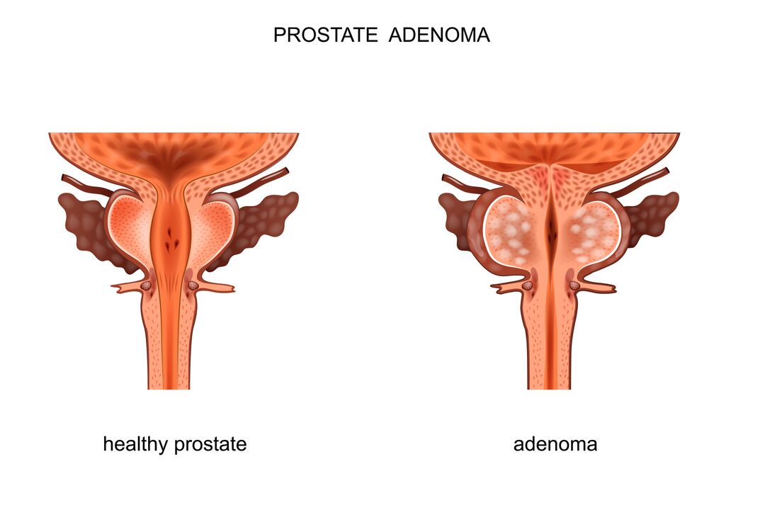 Prostata sana e adenoma