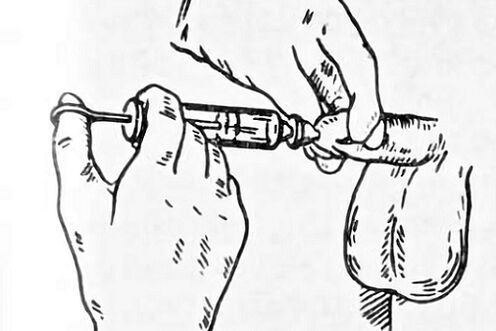 instillazioni per la prostatite