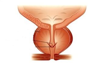 prostatite e il suo trattamento con farmaci