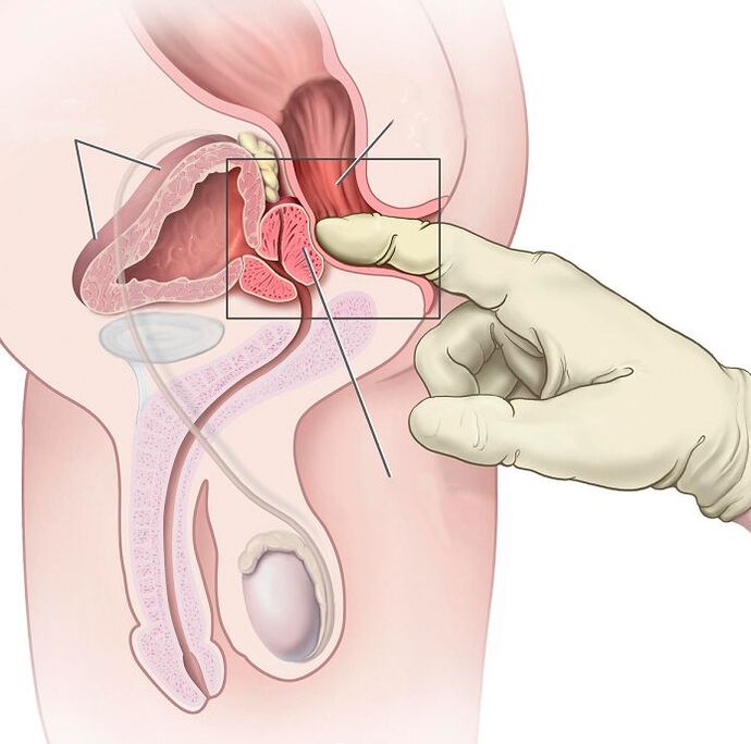 Massaggio prostatico per il trattamento della prostatite