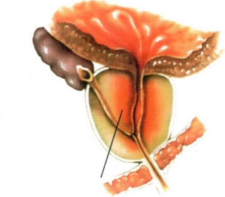 Infiammazione del tessuto prostatico nella prostatite cronica